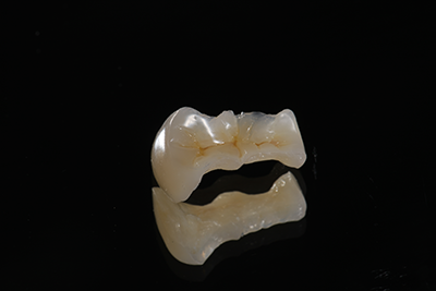 オールセラミックインレー