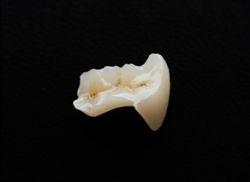 ハイブリッドセラミックインレー