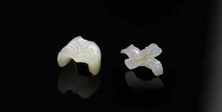 ジルコニアインレー