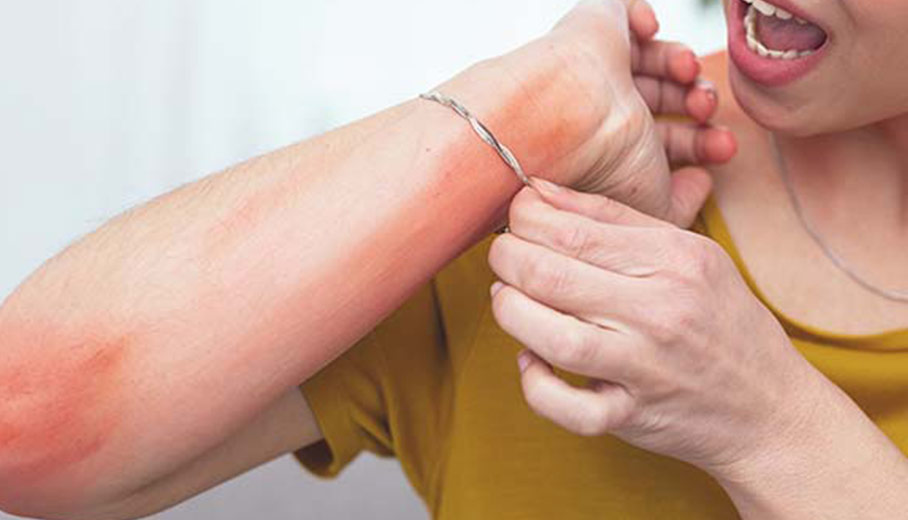 金属アレルギー