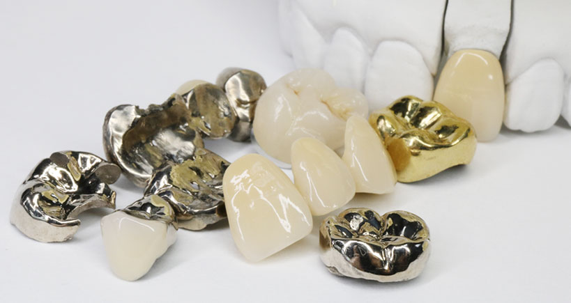 お口の中に入っている可能性のある金属